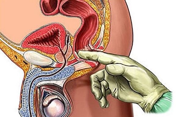 Prostatamassage als Methode zur Behandlung von Prostatitis