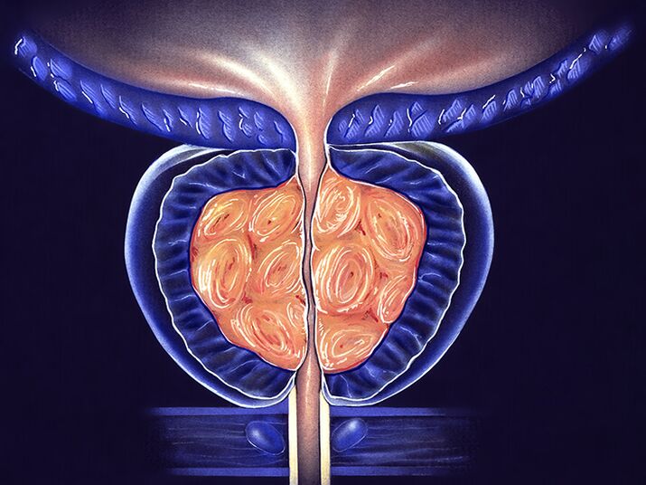 Vorbeugung von entzündeter Prostata und Prostatitis