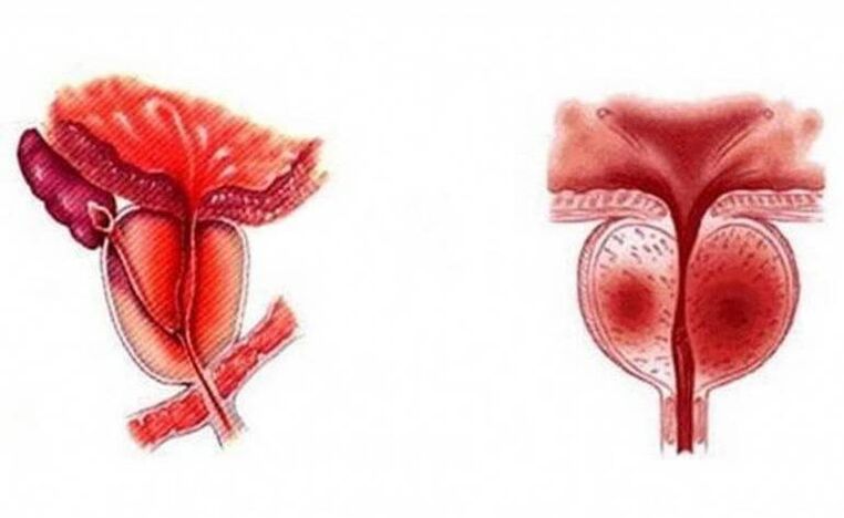 Akute Entzündung der Prostata, die chronisch werden kann